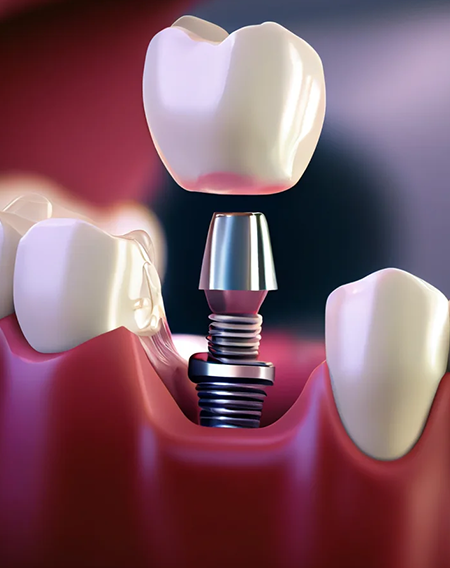 Dental İmplant, İmplant Tedavisi