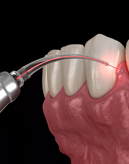 Dental Lazer Tedavileri, Diş Eti Tedavileri
